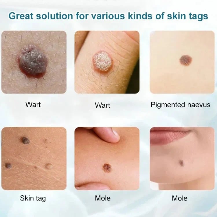 🔥LAST DAY 49% OFF🔥 - SEAGRIL-Concentrated Potent Skin Tag Removal Cream